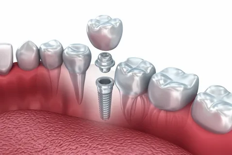 Dental Implant Recovery Period